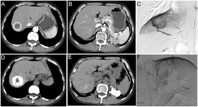 Case report: Drug-eluting bead transcatheter arterial chemoembolization in liver metastasis and retroperitoneal lymph node metastases of renal cell carcinoma: effective local therapy with the first report